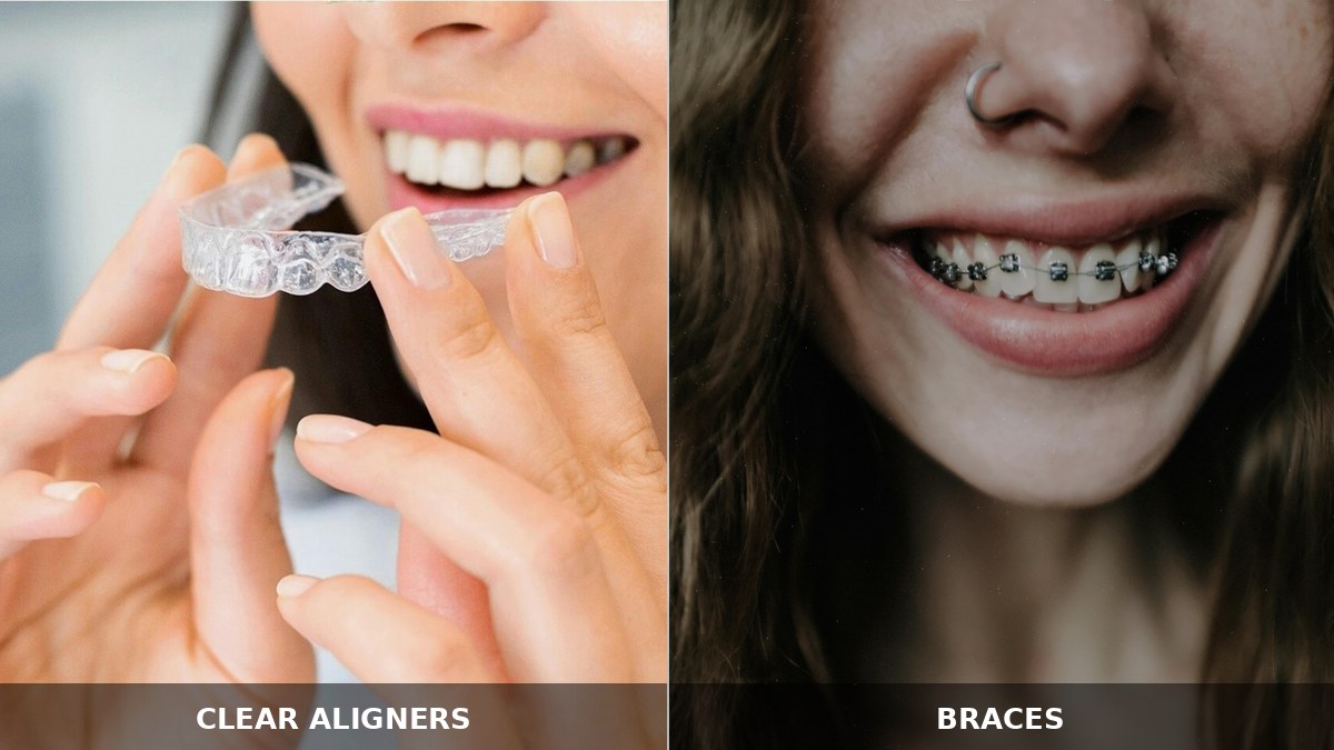 Clear aligners versus traditional metal braces — side-by-side comparison