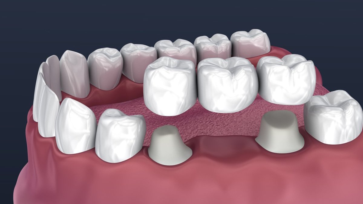 Dental crown and bridge placement on prepared teeth