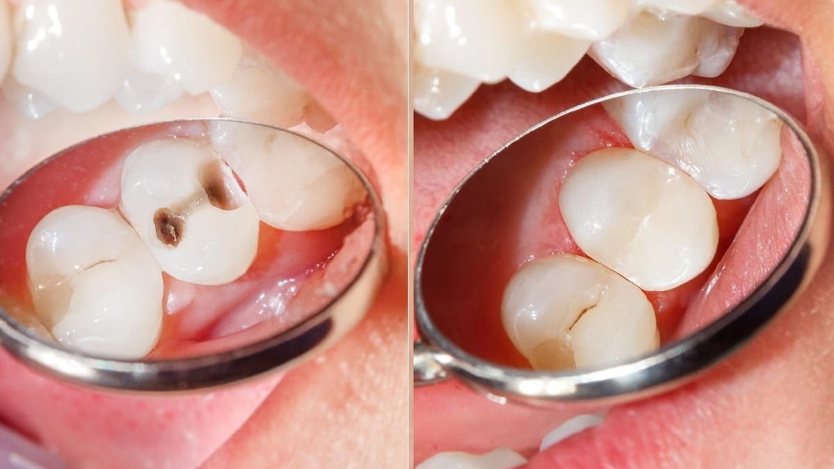 Before-and-after: a cavity restored with a tooth-coloured composite filling