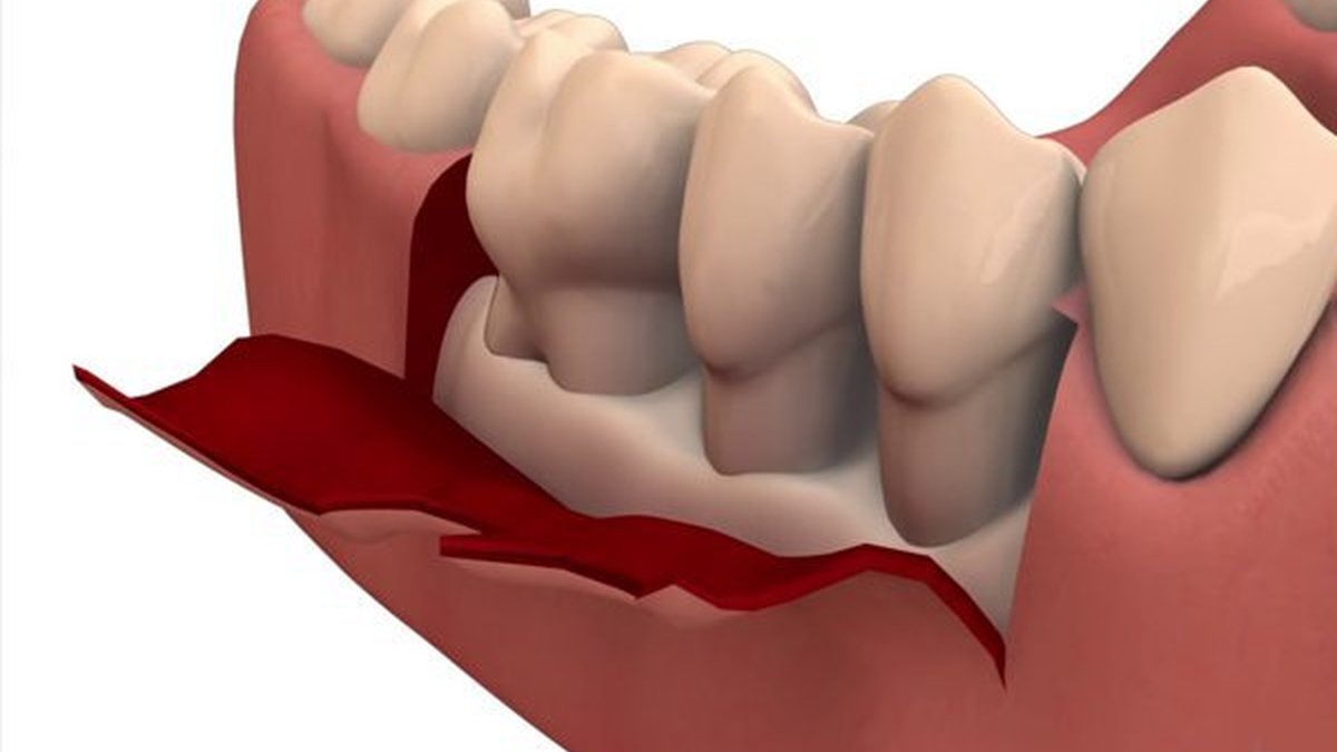 Illustration of flap surgery — gum tissue gently lifted to clean deep below