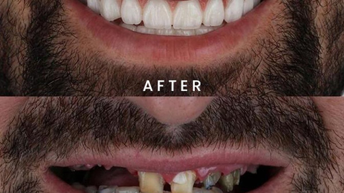 Before-and-after: full mouth rehabilitation restores a complete, confident smile