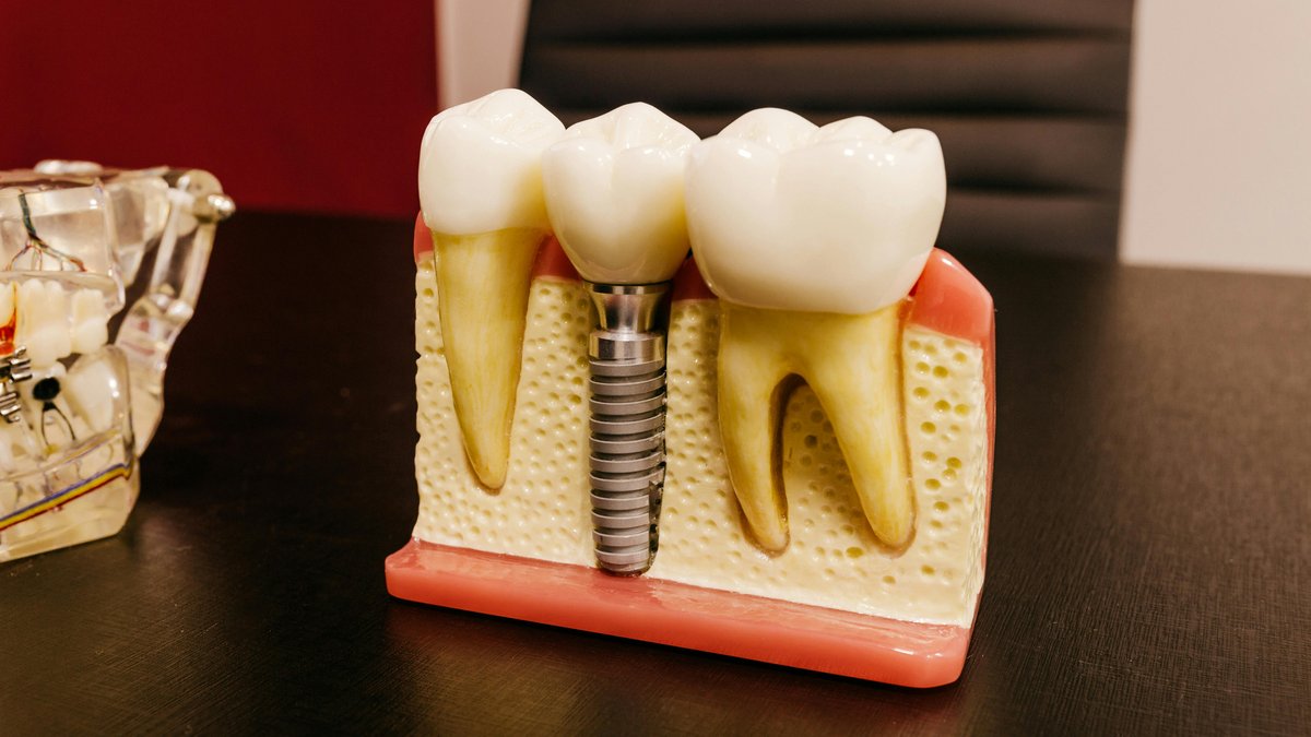 A real anatomical model showing how a dental implant integrates between natural teeth