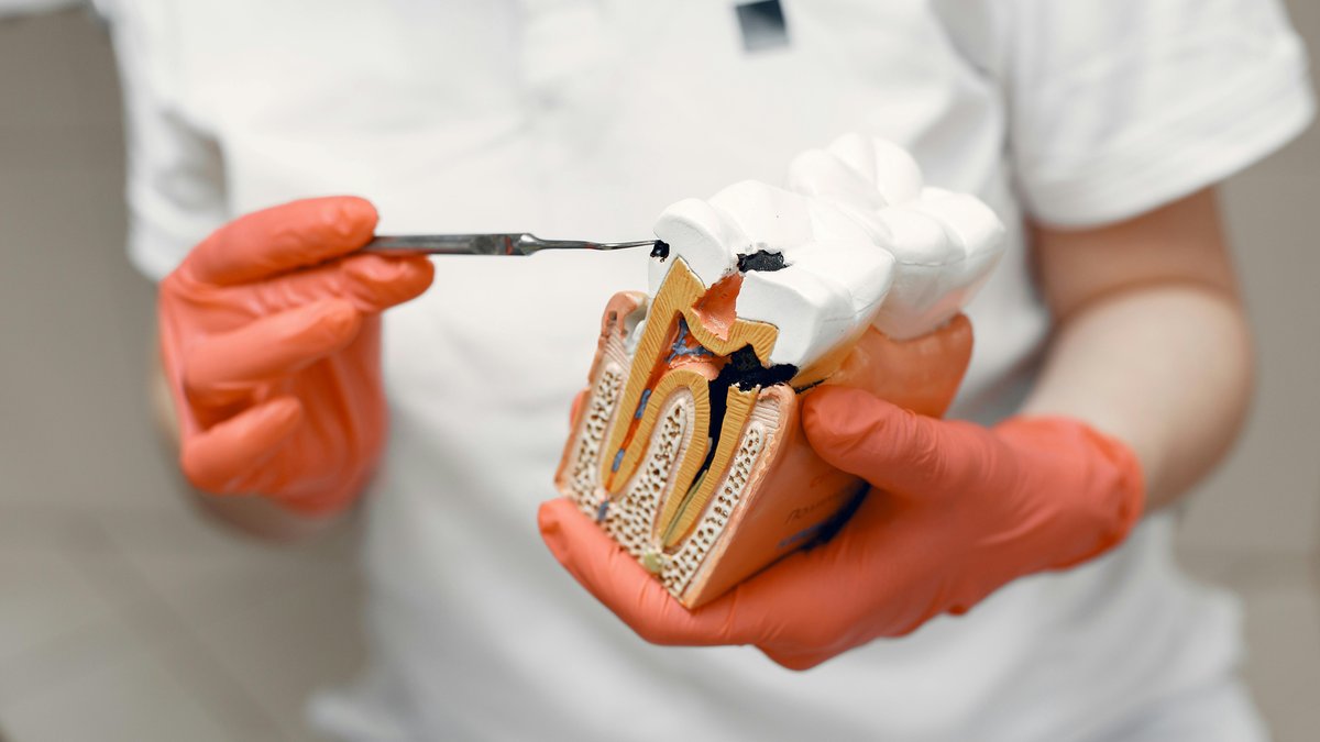 Dentist holding an anatomical tooth model showing the inner pulp chamber treated during root canal