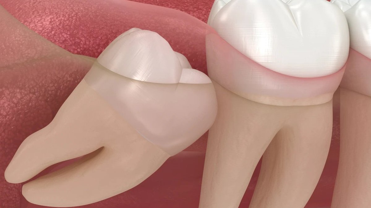 Illustration showing an impacted wisdom tooth pushing against the adjacent molar